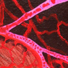 Sickle cell 2