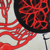 Sickle cell