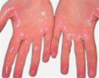 Researchers set sights on permanent cure for excessive sweating