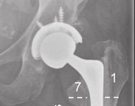 DMU research with international partners reveals how and why some hip implants fail over time