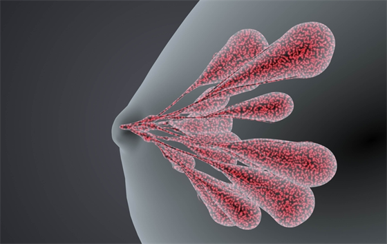Inset lobular breast cancer