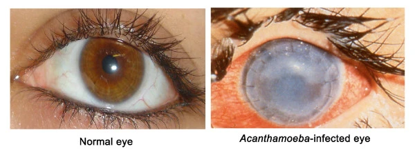 Image showing a normal eye and a Acanthamoeba-infected eye