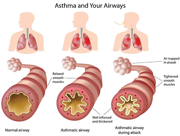 what-is-asthma