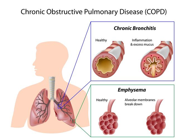 what-is-copd